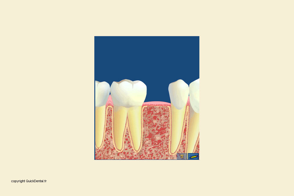dentparis.com - cabinet dentaire damien labonde - implantologie - phase 1