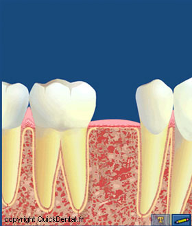 Pose d'implants - phase 1 2 et 3