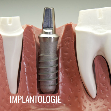 Cabinet Dentaire Damien Labonde et Quentin Dantan : Implantologie