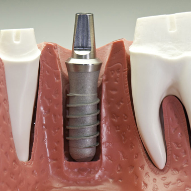 Cabinet Dentaire Damien Labonde Dentparis : Implantologie