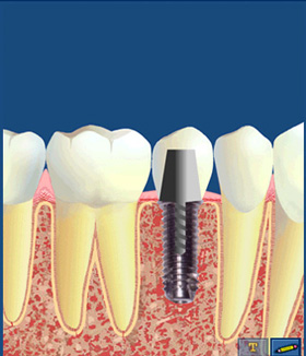 Cabinet dentaire Damien Labonde - implantologie : processus
