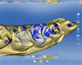 Cabinet Dentaire Damien Labonde et Quentin Dantan - Process Cerec